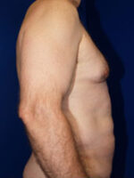 Abdominoplasty