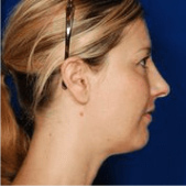 Rhinoplasty