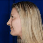 Rhinoplasty