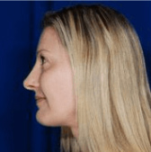 Rhinoplasty