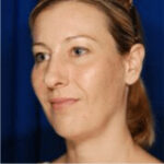 Rhinoplasty