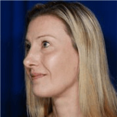 Rhinoplasty