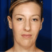 Rhinoplasty