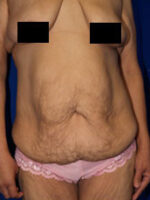 Abdominoplasty