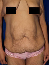 Abdominoplasty