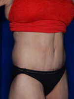 Abdominoplasty