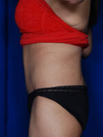 Abdominoplasty