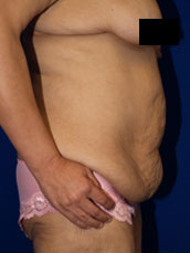 Abdominoplasty