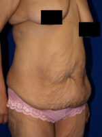 Abdominoplasty