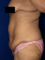 Abdominoplasty