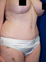 Abdominoplasty