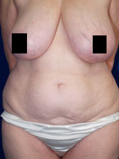 Abdominoplasty