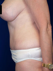 Abdominoplasty