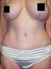 Abdominoplasty