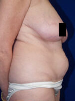 Abdominoplasty