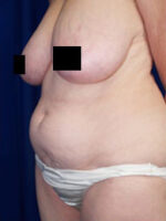 Abdominoplasty