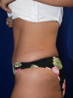 Abdominoplasty