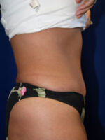 Abdominoplasty