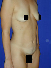 Abdominoplasty