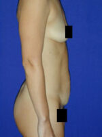 Abdominoplasty