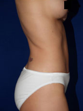 Abdominoplasty