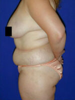 Abdominoplasty