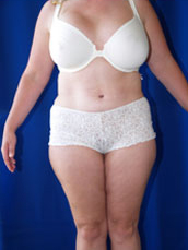 Abdominoplasty