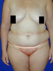 Abdominoplasty