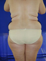 Abdominoplasty