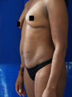 Abdominoplasty