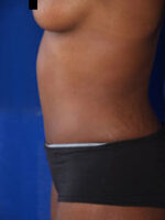Abdominoplasty
