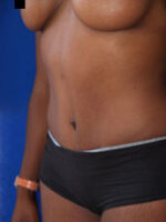 Abdominoplasty