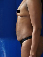 Abdominoplasty