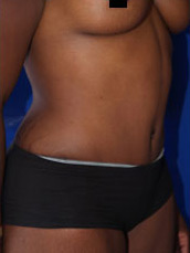 Abdominoplasty