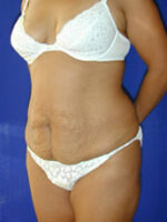 Abdominoplasty