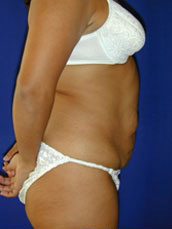 Abdominoplasty