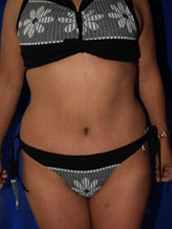 Abdominoplasty