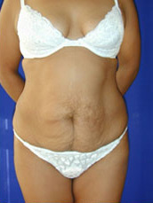 Abdominoplasty