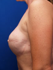 Breast Reconstruction
