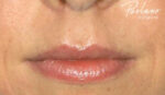 Fillers/Volume Restoration