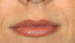 Fillers/Volume Restoration