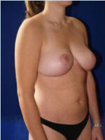 Breast Lift