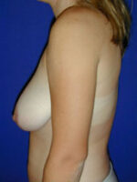 Breast Lift
