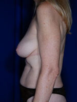 Breast Fat Transfer