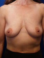 Breast Augmentation & Lift