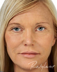 Fillers/Volume Restoration