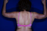 Liposuction