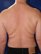 Male Liposuction