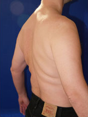 Male Liposuction