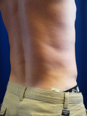 Male Liposuction